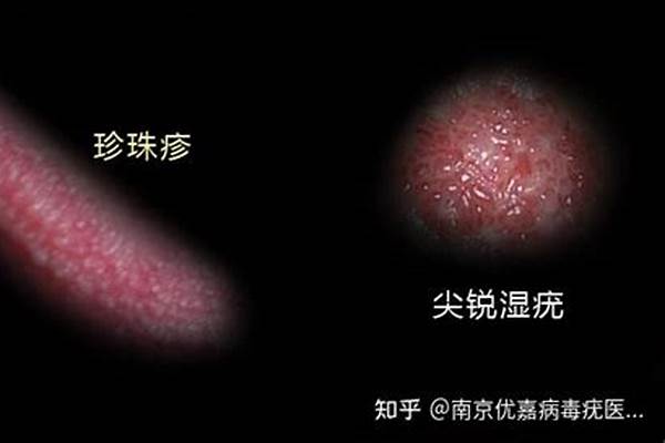 珍珠状丘疹病是怎么回事了
